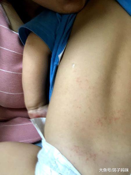 误以为感冒, 妈妈讲述儿子川崎病的亲身经历!