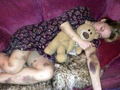 女人身上有淤青, 去医院检查才知得了绝症, 都听过总被我们忽略