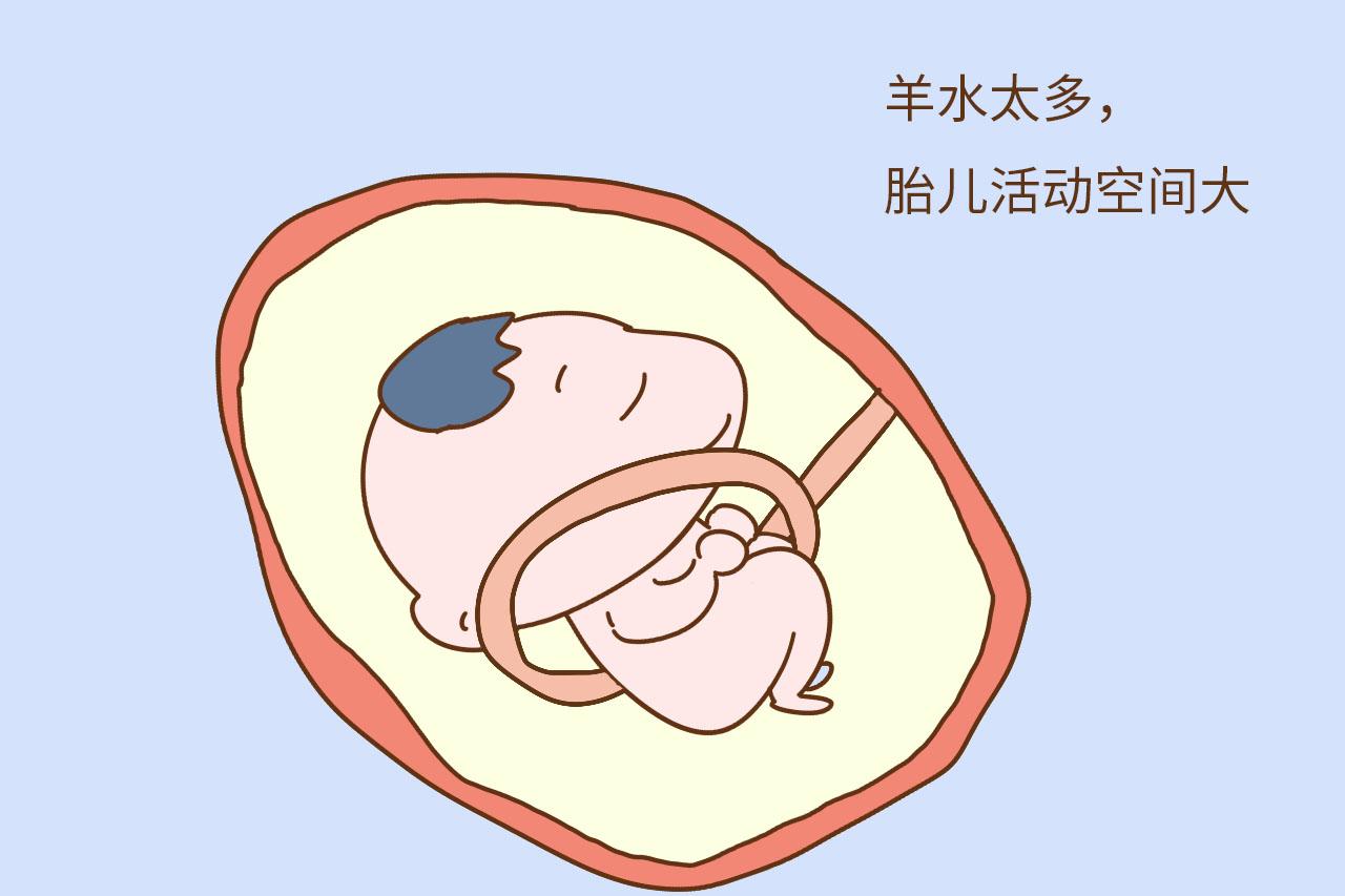 胎儿脐带绕颈是孕妈运动不当导致的? 别冤枉人, 这些情况才是主因