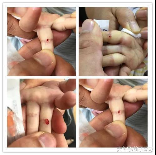 孩子得了疳积, 针挑四缝最管用!