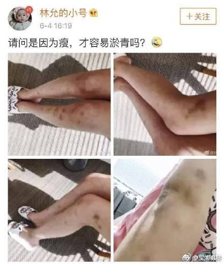 林允方回应腿部淤青: 吊威亚及下水拍戏所致