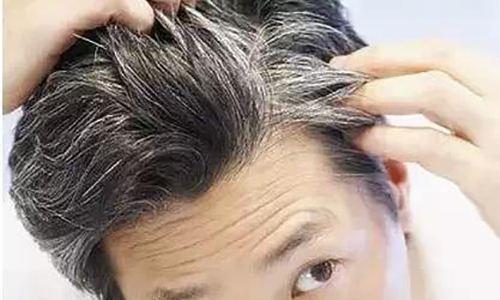 为何有“少年白发”? 可能是你这里出问题了, 不注意就得后悔了!