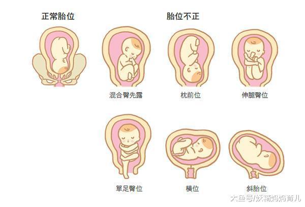 胎儿难产的5大原因, 孕期做好这三点, 分娩更顺利
