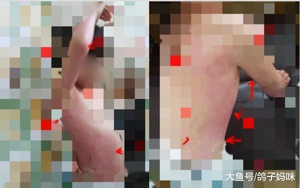 热汤放教室女孩被烫下病危, 幼儿园竟不闻不问!