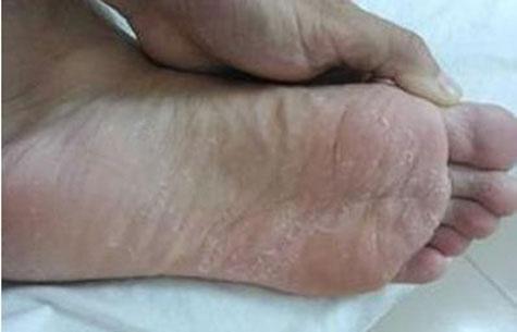 脚气老治不好, 去厨房找点调料, 每家每户都有, 用来泡脚效果好