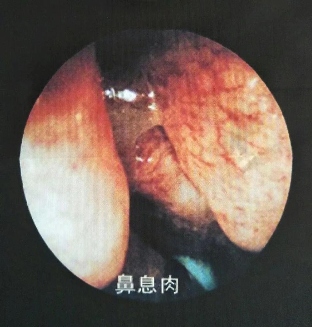 我的鼻息肉很多年了,7年前做过手术,现在又复发了怎么