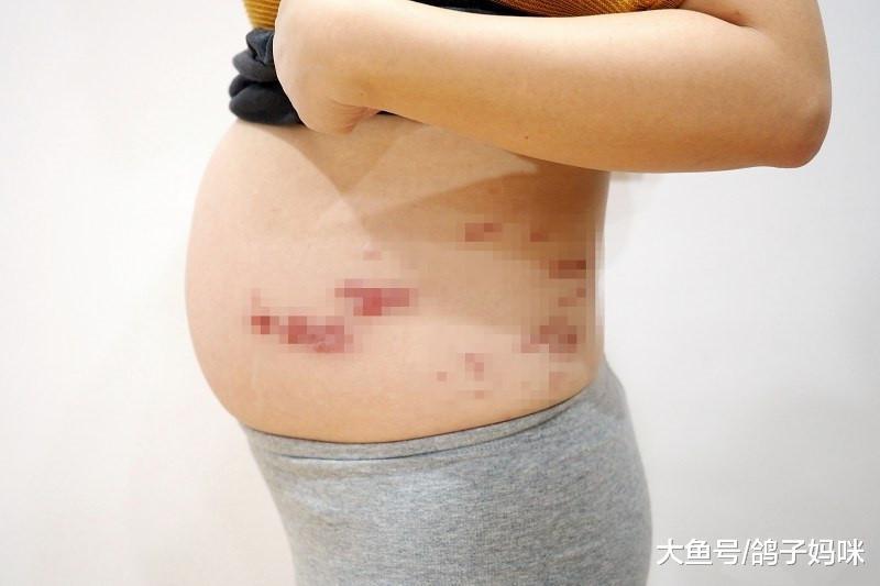 怀孕日记二宝孕中期, 麻烦的带状疱疹