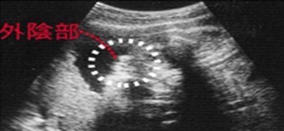 四维B超看男女准吗? 教您如何通过四维彩超判断男女