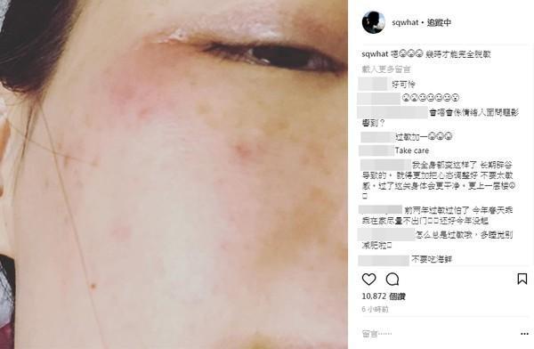 舒淇停工4个月旧疾复发! 红疹再度侵袭脸蛋