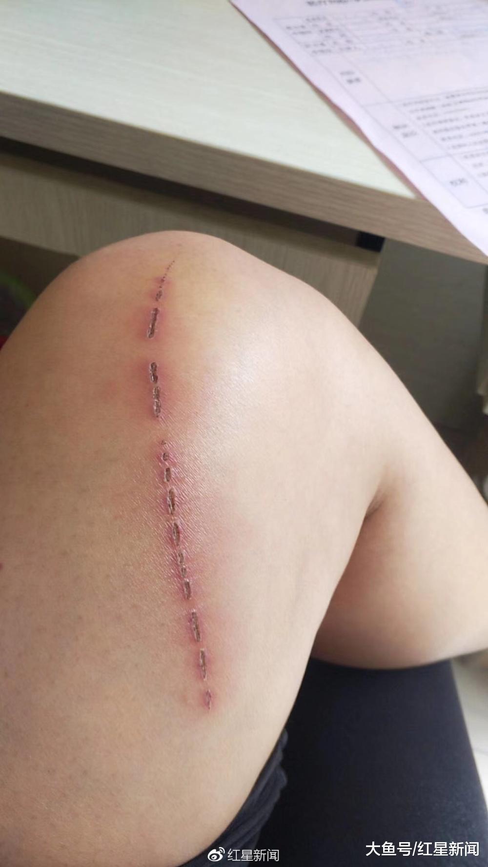 云南女孩报警: 她被注射了过期的狂犬病疫苗