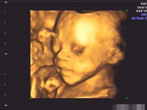 小棉袄顺利通过四维大排畸, 孕期症状分享