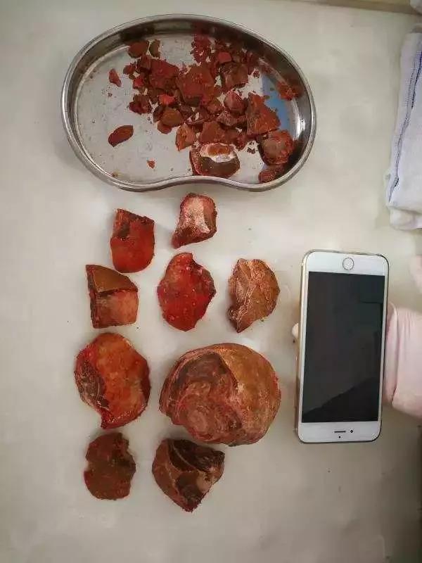 男子憋尿憋到尿不出, 医生检查后, 顿时觉得男子太恶心