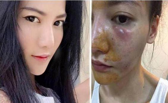 泰国美女每天坚持打美白针, 6年后皮肤发黑变成这样