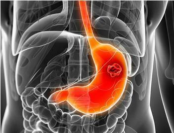 老娘确诊胃癌, 儿女为家里财产大打出手! 医生: 三类人要小心胃癌