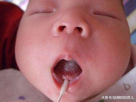 宝宝得了鹅口疮怎么办? 6大穴位按摩缓解宝宝鹅口疮, 试一个好一个
