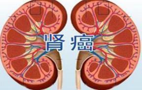 33岁男子查出肾癌, 父母痛哭不止! 医生: 年轻人要改4个习惯