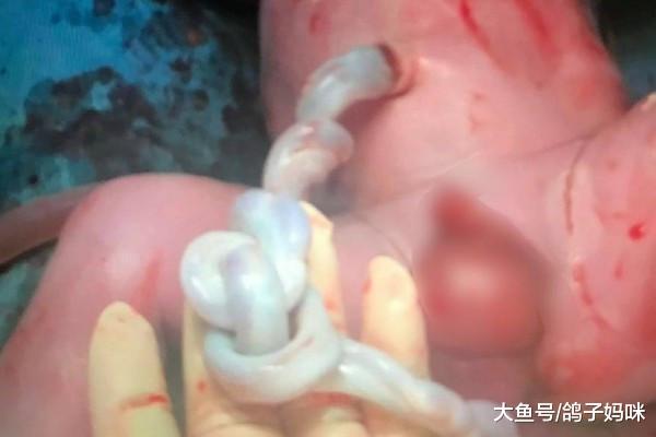 胎儿脐带竟打死结! 心跳奇怪, 改剖腹救回一命