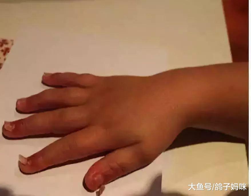 孩子指甲一个个脱落, 罪魁祸首是手足口病!