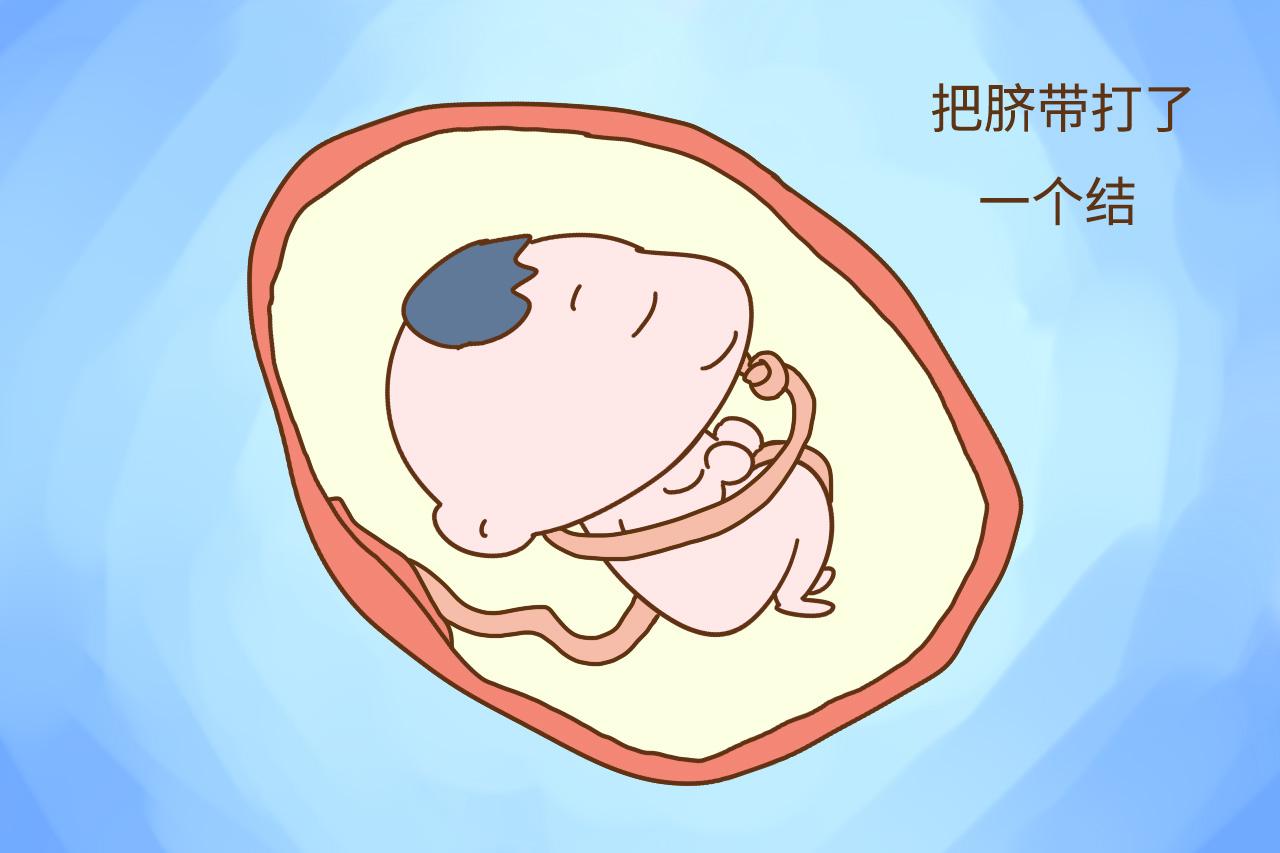 脐带绕颈、脐带打结很危险? 这些事情孕妈要了解