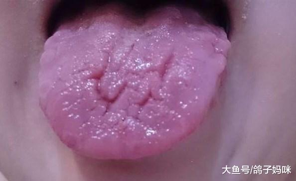 爸妈必看! 孩子舌头有裂痕破洞? 那可不是肠病毒