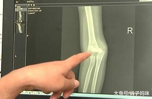 暑假, 孩子玩平衡车安全事故频发, 谨防骨折!