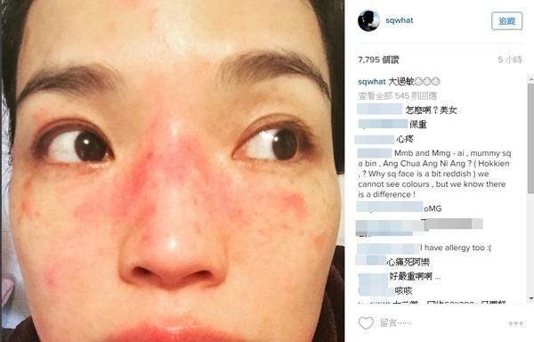 舒淇停工4个月旧疾复发! 红疹再度侵袭脸蛋