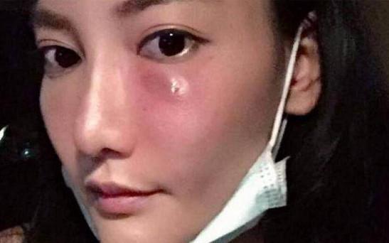 泰国美女每天坚持打美白针, 6年后皮肤发黑变成这样