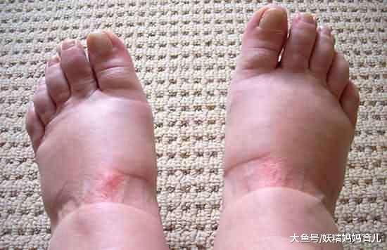 怀孕后期脚肿得像猪蹄, 大夫让我这样做还真管用
