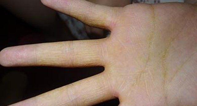 身体1处发麻, 1处发白, 3处发黄, 这是高脂血症的表现, 要警惕!