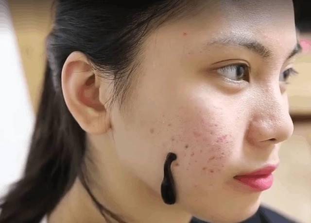 一女子脸上放着一只水蛭却不着急取下, 当把水蛭拿下后却感到神奇