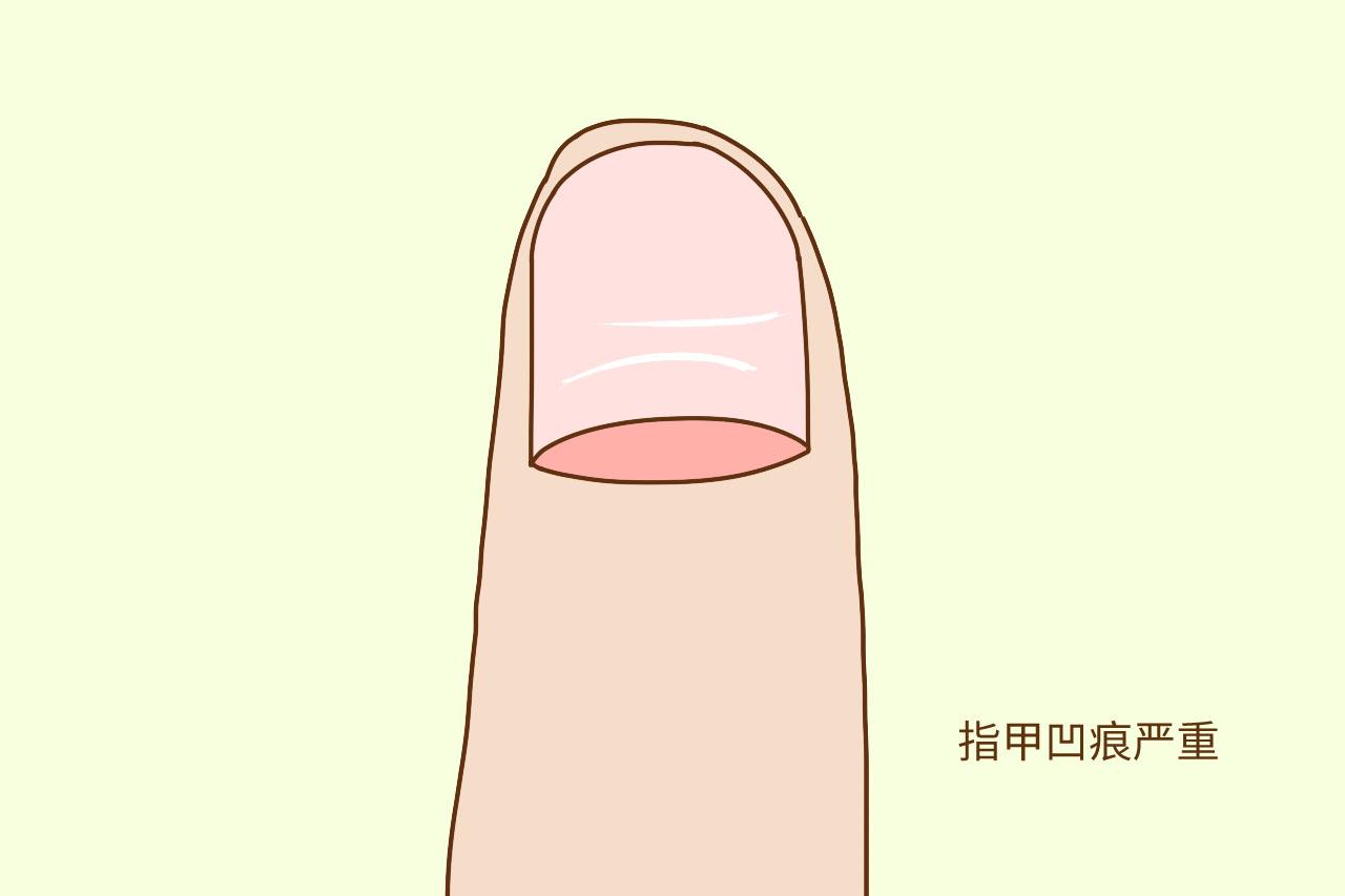 孕期贫血缺钙不自知? 准妈妈学会一招, 看懂自己“身体阴晴表”