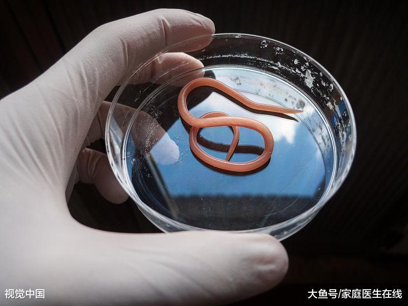 怎么知道肚子里有没有蛔虫? 医生: 可试试这3种