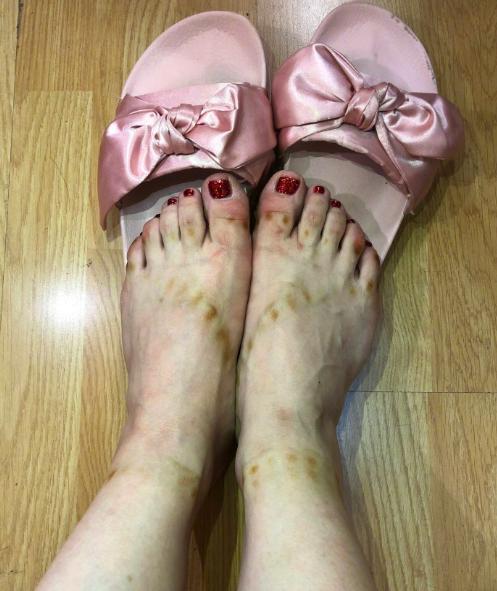 冉莹颖晒双脚淤青照, 穿高跟鞋录10小时节目, 自称脚已残