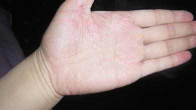 手上经常起密麻小水泡, 痒还脱皮, 到底怎么回事? 大病预兆?