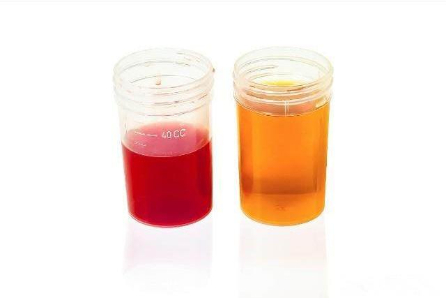 肾病早期, 睡觉时会有这4种表现, 若占一个, 都要抓紧养肾了!