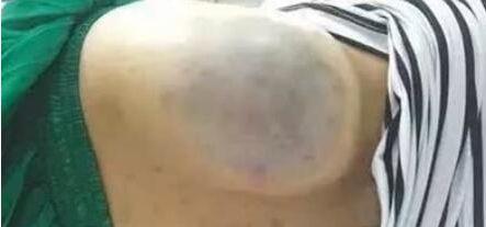 年轻女子内分泌失调, 亲戚为其刮痧, 看完刮出的东西赶紧报了警!