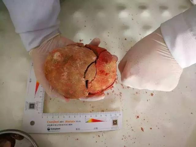 男子憋尿憋到尿不出, 医生检查后, 顿时觉得男子太恶心