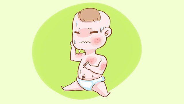宝宝容易起痱子, 该如何是好