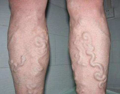 人体“青筋”凸起是大病前兆! 可惜许多人还以为是强壮的象征