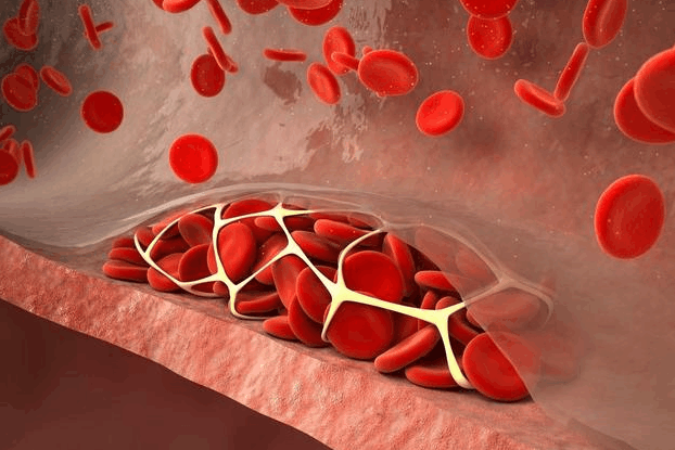 六大信号提醒你, 血栓要来了! 多看一眼, 以后用得着