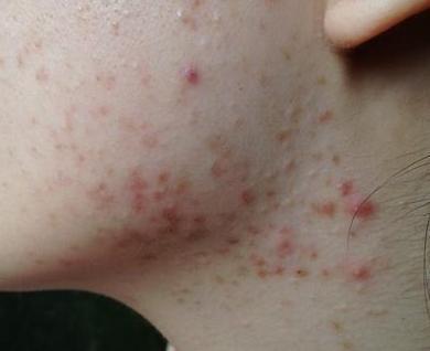 脖子长很多小肉粒, 说明身体出了问题, 长期下去会很严重!