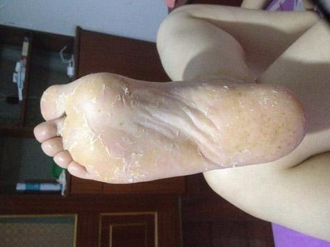 脚气老治不好, 去厨房找点调料, 每家每户都有, 用来泡脚效果好