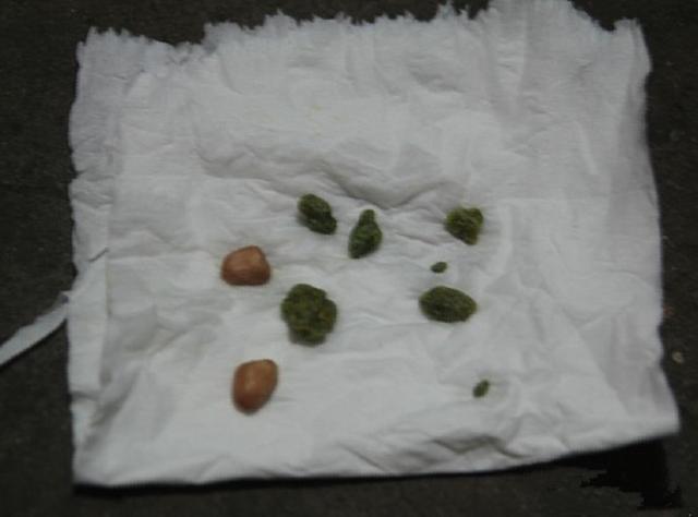 28岁小伙腰部剧痛, 排血尿入院! 医生: 两种食物混合的结果!