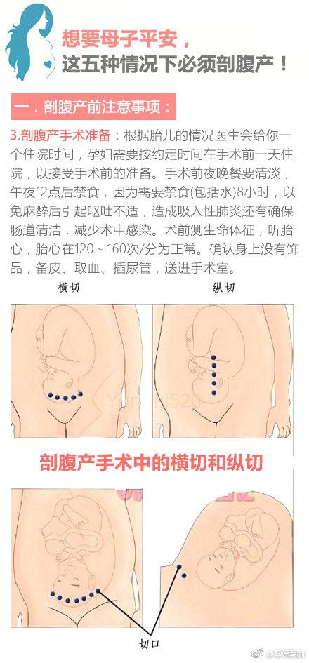 想要母子平安, 这五种情况下最好还是剖腹产!