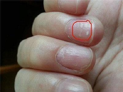 手指甲是人体健康的“指标”, 哪些是疾病的症状你可知?