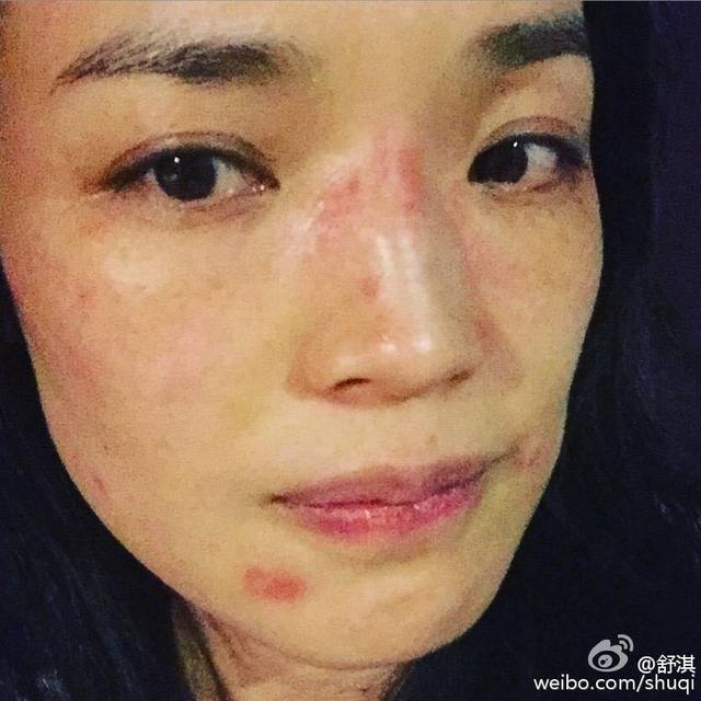 舒淇停工4个月旧疾复发! 红疹再度侵袭脸蛋