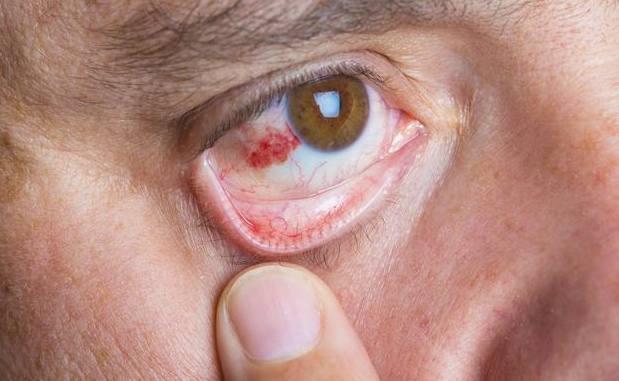 医生提醒: 眼睛有这3个变化, 说明肝脏受损了, 很多人还不知道!