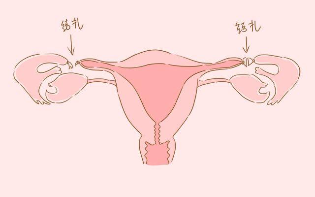 男人到底有多爱老婆, 才会甘愿结扎
