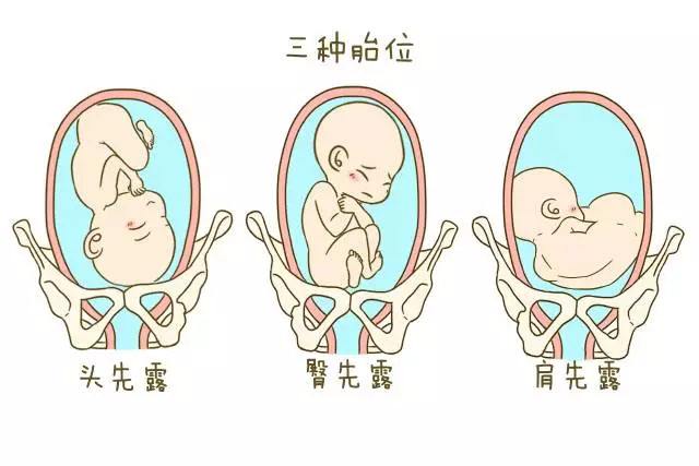 怀男孩一般这种胎位比较多, 看看你是吗?