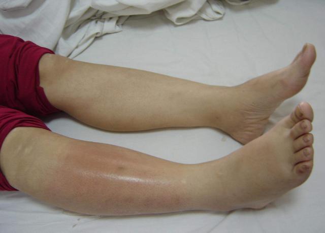 脑血栓来临前, 身体会有4个症状, 希望你不要错过!